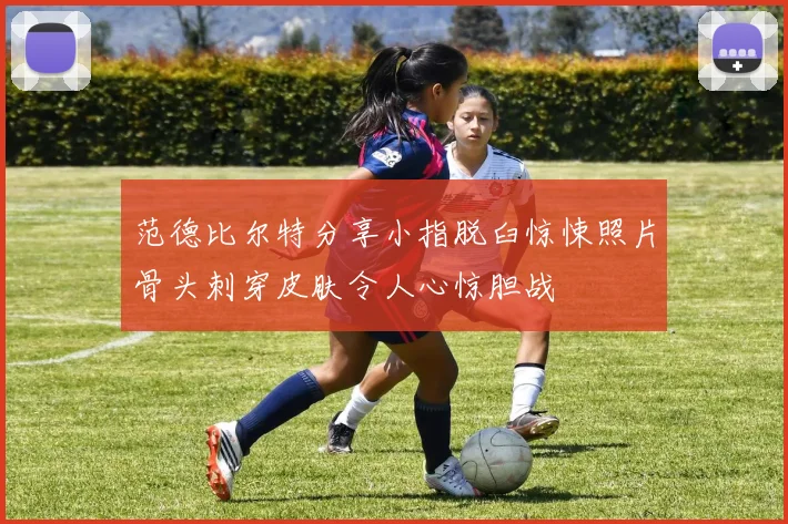 范德比尔特分享小指脱臼惊悚照片骨头刺穿皮肤令人心惊胆战